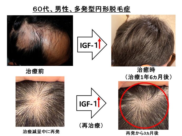 円形脱毛症　病院